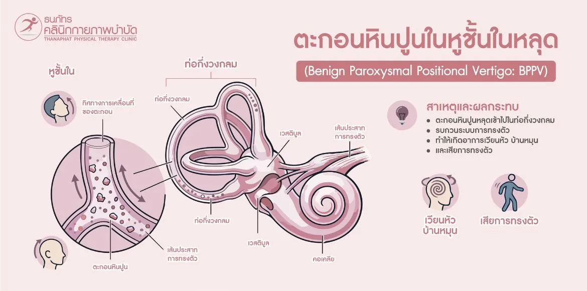 สาเหตุที่พบบ่อยของโรคบ้านหมุน